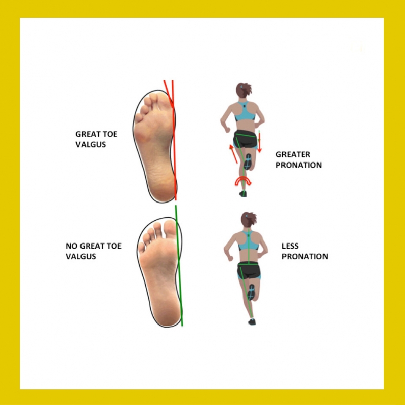 Pronation beim Laufen und deren Auswirkung