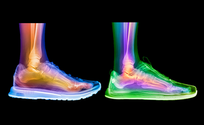 Röntgenbild/Xray Darstellung wie der Fuß im Schuh liegt bei Sprenung und bei Nullabsatz
