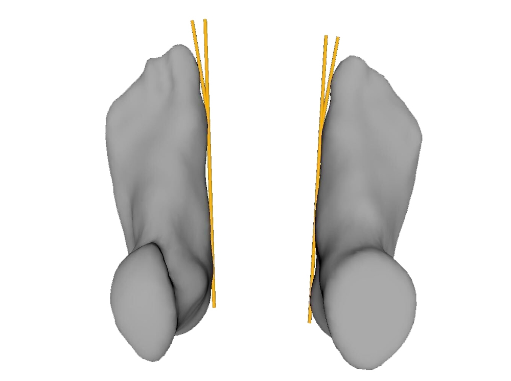 Fußscan des Hallux Winkel